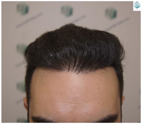 Injerto Capilar Técnica FUE 3681 Grafts (8585 Pelos) 27 TECNICA FUE
