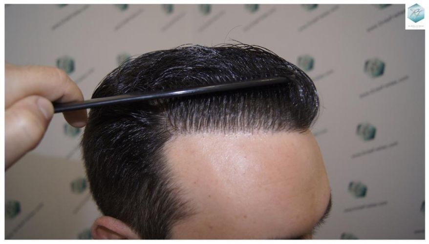 Injerto Capilar Técnica FUE 3681 Grafts (8585 Pelos) 33 TECNICA FUE