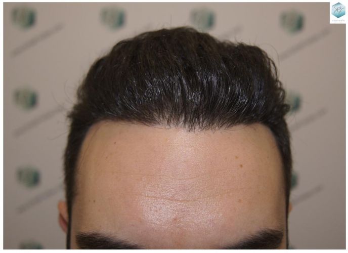 Injerto Capilar Técnica FUE 3681 Grafts (8585 Pelos) 26 TECNICA FUE