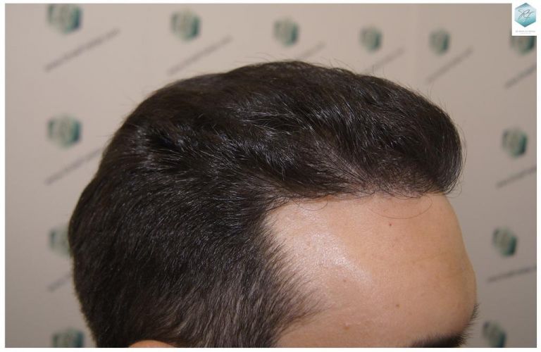 Injerto Capilar Técnica FUE 3681 Grafts (8585 Pelos) 32 TECNICA FUE