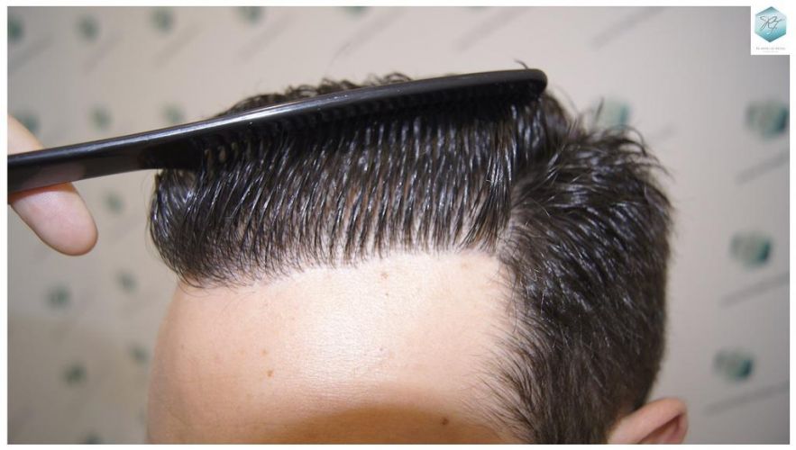 Injerto Capilar Técnica FUE 3681 Grafts (8585 Pelos) 37 TECNICA FUE