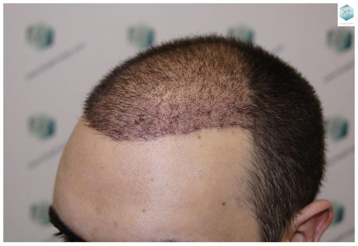 Injerto Capilar Técnica FUE 3681 Grafts (8585 Pelos) 25 TECNICA FUE