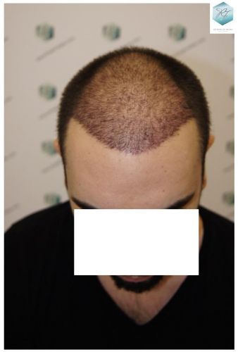Injerto Capilar Técnica FUE 3681 Grafts (8585 Pelos) 23 TECNICA FUE
