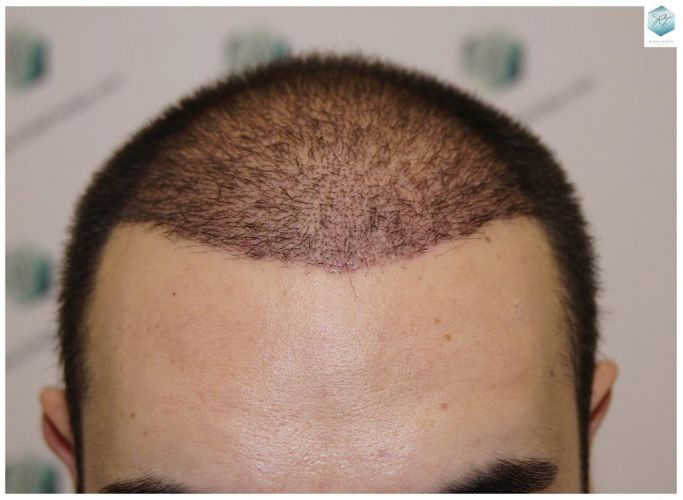Injerto Capilar Técnica FUE 3681 Grafts (8585 Pelos) 22 TECNICA FUE