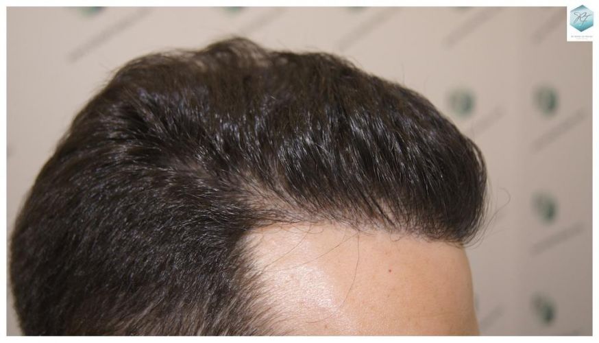 Injerto Capilar Técnica FUE 3681 Grafts (8585 Pelos) 34 TECNICA FUE