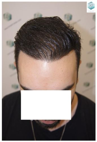 Injerto Capilar Técnica FUE 3681 Grafts (8585 Pelos) 29 TECNICA FUE