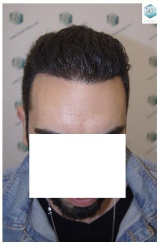 Injerto Capilar Técnica FUE 3681 Grafts (8585 Pelos) 30 TECNICA FUE