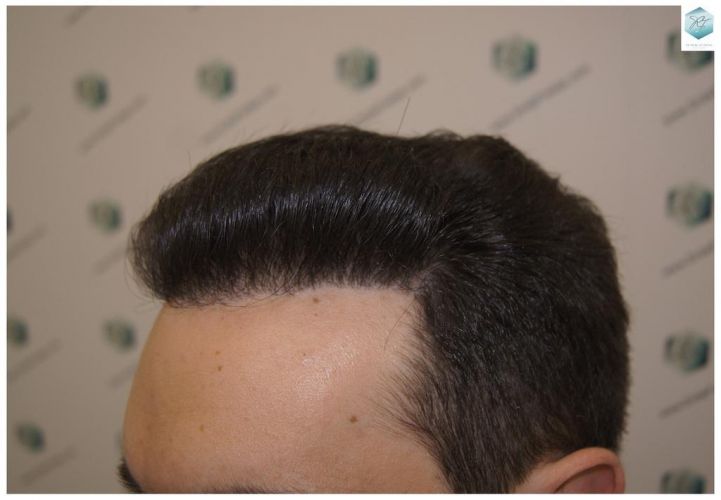 Injerto Capilar Técnica FUE 3681 Grafts (8585 Pelos) 36 TECNICA FUE