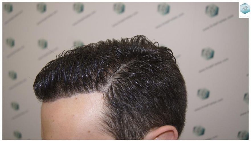 Injerto Capilar Técnica FUE 3681 Grafts (8585 Pelos) 35 TECNICA FUE