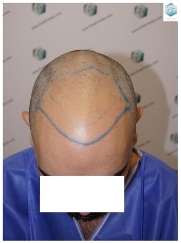 Injerto Capilar Técnica FUE 3681 Grafts (8585 Pelos) 10 TECNICA FUE