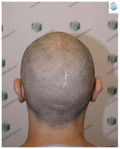 Injerto Capilar Técnica FUE 3681 Grafts (8585 Pelos) 13 TECNICA FUE