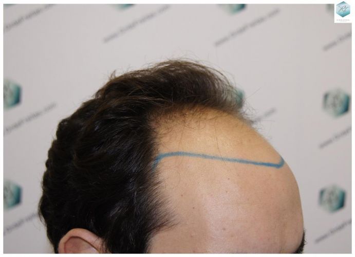 Injerto Capilar Técnica FUE 3681 Grafts (8585 Pelos) 7 TECNICA FUE