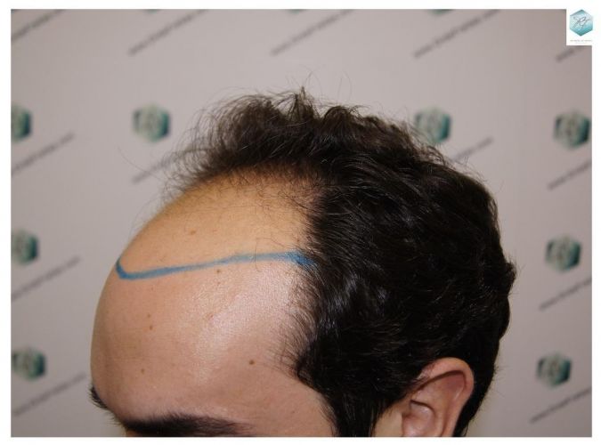 Injerto Capilar Técnica FUE 3681 Grafts (8585 Pelos) 8 TECNICA FUE