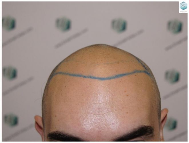 Injerto Capilar Técnica FUE 3681 Grafts (8585 Pelos) 11 TECNICA FUE