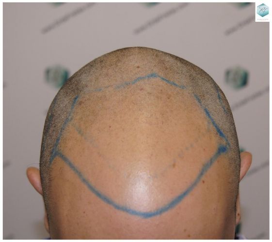 Injerto Capilar Técnica FUE 3681 Grafts (8585 Pelos) 12 TECNICA FUE