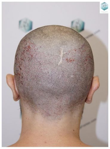 Injerto Capilar Técnica FUE 3681 Grafts (8585 Pelos) 21 TECNICA FUE