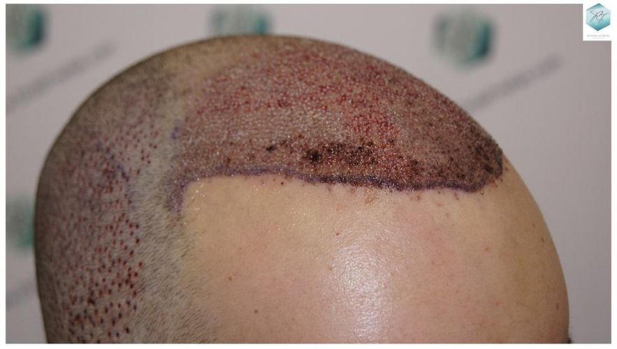 Injerto Capilar Técnica FUE 3681 Grafts (8585 Pelos) 18 TECNICA FUE