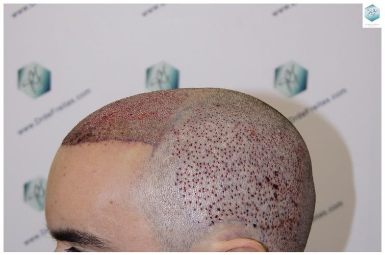 Injerto Capilar Técnica FUE 3681 Grafts (8585 Pelos) 20 TECNICA FUE