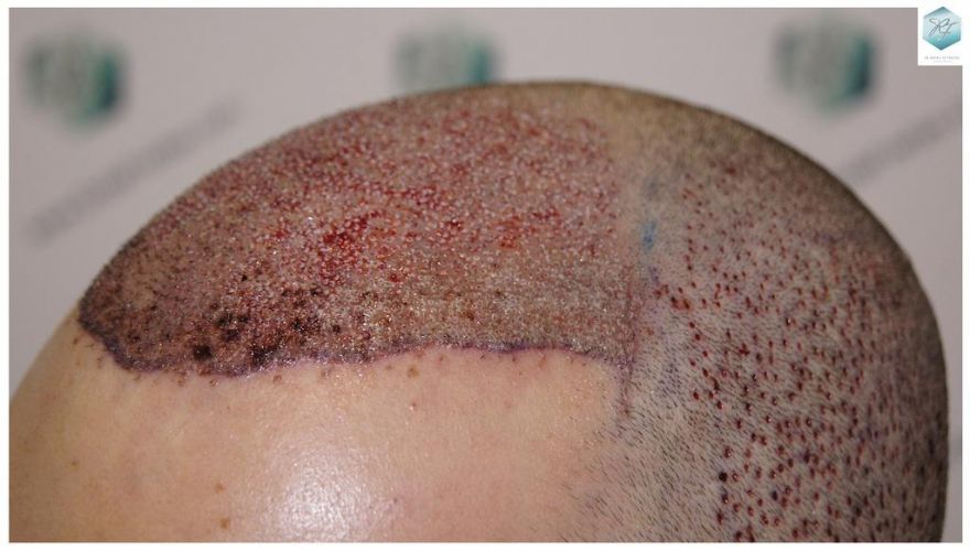 Injerto Capilar Técnica FUE 3681 Grafts (8585 Pelos) 19 TECNICA FUE