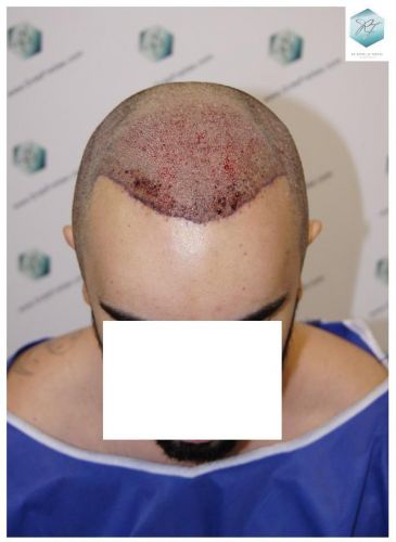 Injerto Capilar Técnica FUE 3681 Grafts (8585 Pelos) 16 TECNICA FUE