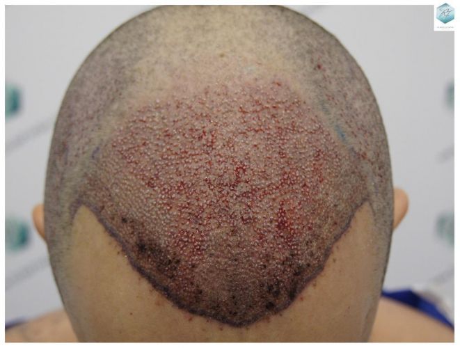Injerto Capilar Técnica FUE 3681 Grafts (8585 Pelos) 15 TECNICA FUE