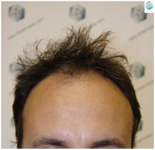 Injerto Capilar Técnica FUE 1.683 Grafts (Pelos 3705) 1 TECNICA FUE