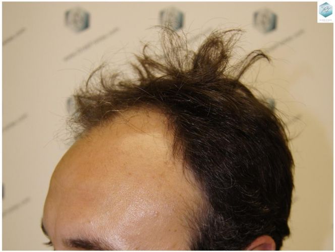 Injerto Capilar Técnica FUE 1.683 Grafts (Pelos 3705) 4 TECNICA FUE