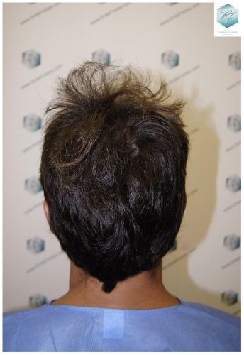Injerto Capilar Técnica FUE 1.683 Grafts (Pelos 3705) 10 TECNICA FUE