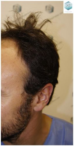 Injerto Capilar Técnica FUE 1.683 Grafts (Pelos 3705) 6 TECNICA FUE