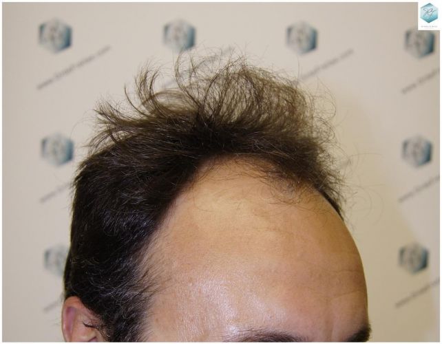 Injerto Capilar Técnica FUE 1.683 Grafts (Pelos 3705) 3 TECNICA FUE