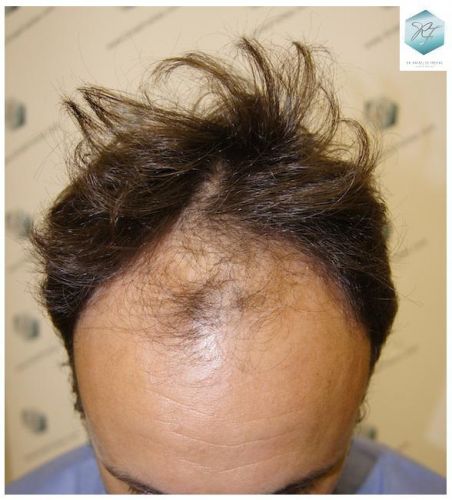 Injerto Capilar Técnica FUE 1.683 Grafts (Pelos 3705) 2 TECNICA FUE
