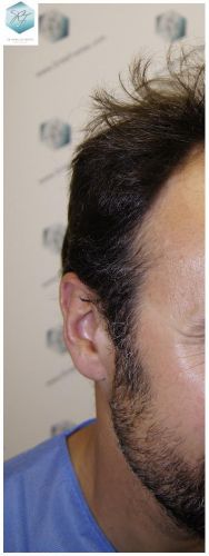 Injerto Capilar Técnica FUE 1.683 Grafts (Pelos 3705) 5 TECNICA FUE