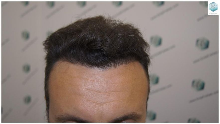 RESULTADOS A LOS 12 MESES DESPUES DE UN TRASPLANTE DE PELO