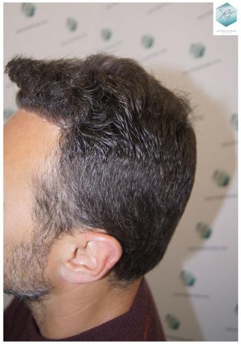 Injerto Capilar Técnica FUE 1.683 Grafts (Pelos 3705) 53 DESPUES DE UN TRASPLANTE DE PELO