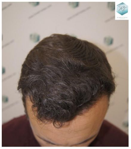 Injerto Capilar Técnica FUE 1.683 Grafts (Pelos 3705) 35 DESPUES DE UN TRASPLANTE DE PELO