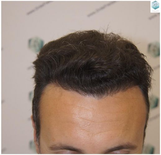 Injerto Capilar Técnica FUE 1.683 Grafts (Pelos 3705) 37 DESPUES DE UN TRASPLANTE DE PELO