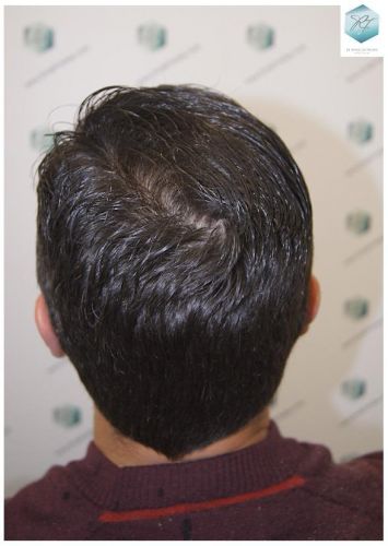Injerto Capilar Técnica FUE 1.683 Grafts (Pelos 3705) 56 DESPUES DE UN TRASPLANTE DE PELO