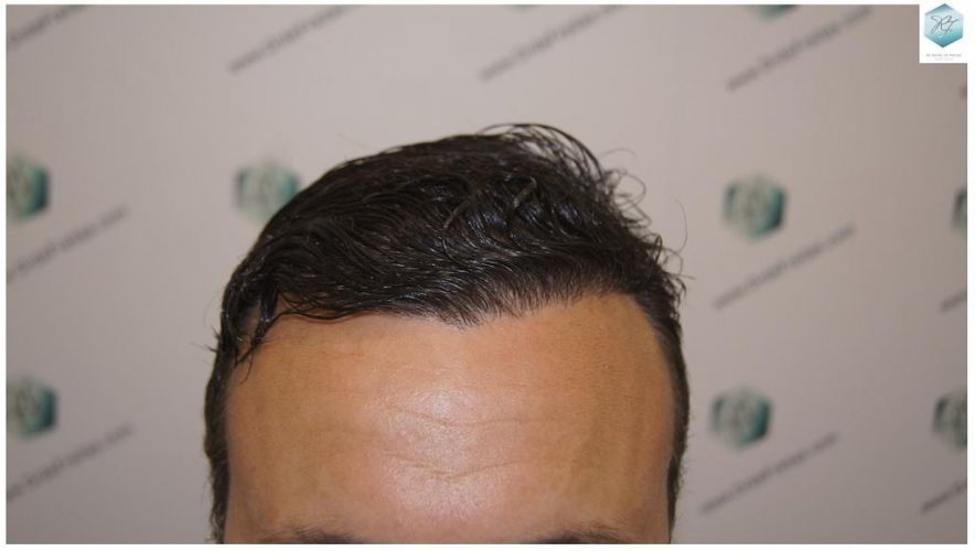 Injerto Capilar Técnica FUE 1.683 Grafts (Pelos 3705) 34 DESPUES DE UN TRASPLANTE DE PELO