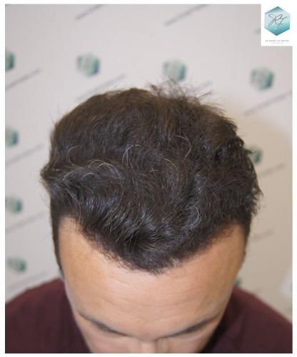 Injerto Capilar Técnica FUE 1.683 Grafts (Pelos 3705) 33 DESPUES DE UN TRASPLANTE DE PELO