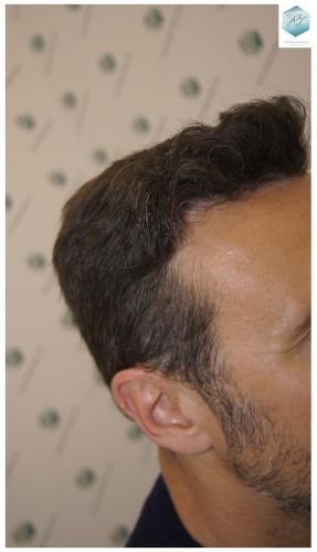 Injerto Capilar Técnica FUE 1.683 Grafts (Pelos 3705) 41 INJERTO CAPILAR