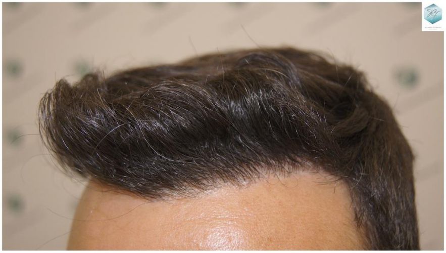 Injerto Capilar Técnica FUE 1.683 Grafts (Pelos 3705) 50 INJERTO CAPILAR
