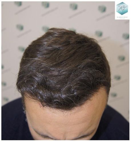 Injerto Capilar Técnica FUE 1.683 Grafts (Pelos 3705) 38 INJERTO CAPILAR