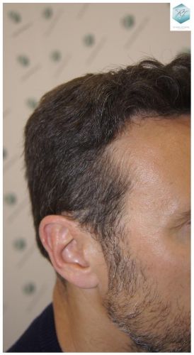 Injerto Capilar Técnica FUE 1.683 Grafts (Pelos 3705) 40 DESPUES DE UN TRASPLANTE DE PELO