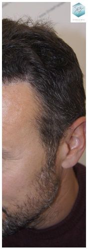 Injerto Capilar Técnica FUE 1.683 Grafts (Pelos 3705) 52 INJERTO CAPILAR