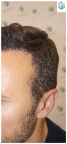Injerto Capilar Técnica FUE 1.683 Grafts (Pelos 3705) 51 INJERTO CAPILAR