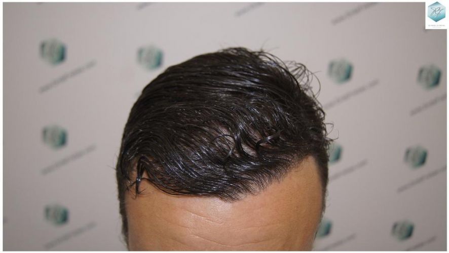 Injerto Capilar Técnica FUE 1.683 Grafts (Pelos 3705) 55 INJERTO CAPILAR