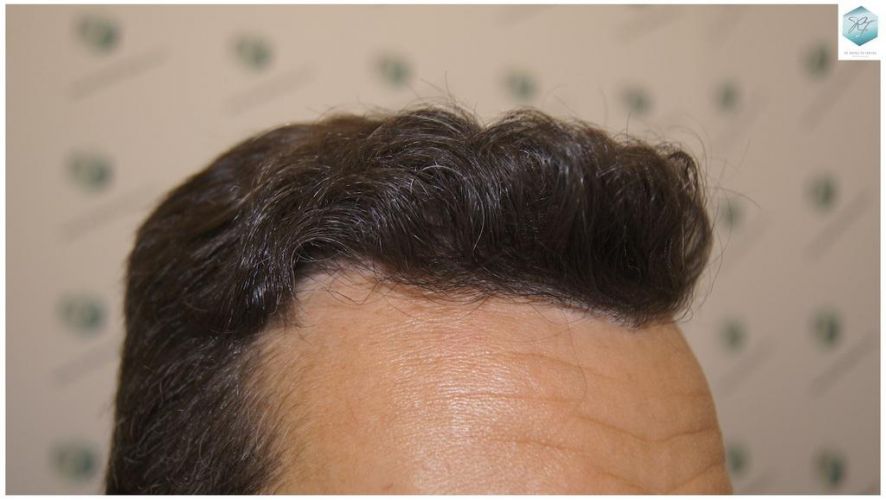 Injerto Capilar Técnica FUE 1.683 Grafts (Pelos 3705) 47 INJERTO CAPILAR