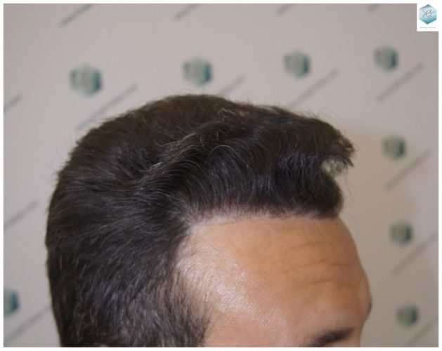 Injerto Capilar Técnica FUE 1.683 Grafts (Pelos 3705) 42 INJERTO CAPILAR