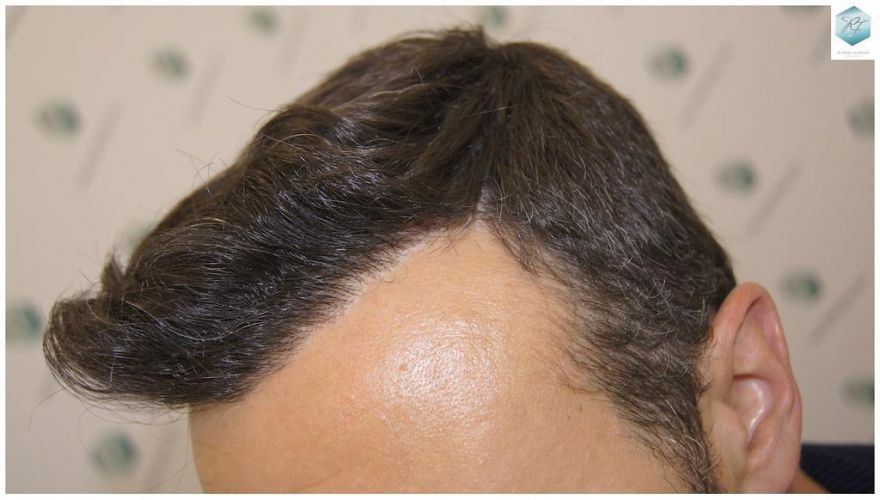 Injerto Capilar Técnica FUE 1.683 Grafts (Pelos 3705) 49 INJERTO CAPILAR