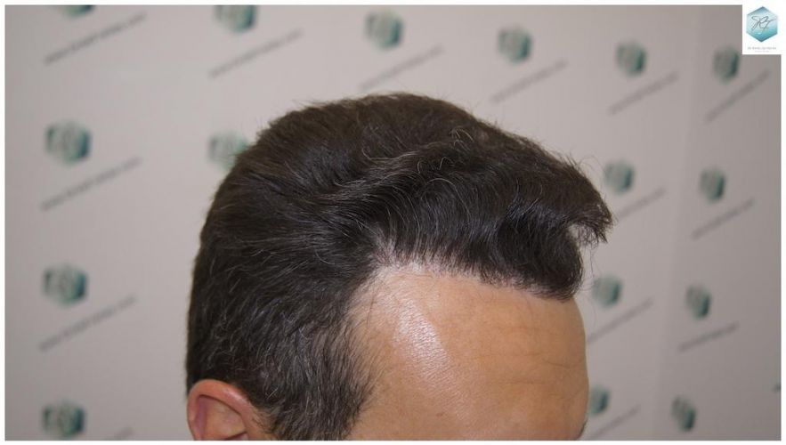 Injerto Capilar Técnica FUE 1.683 Grafts (Pelos 3705) 43 DESPUES DE UN TRASPLANTE DE PELO